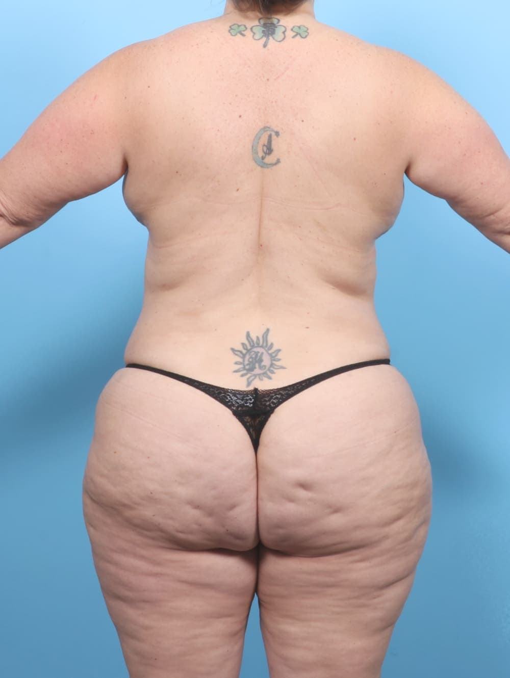 Tummy Tuck case #6793 after, image 4