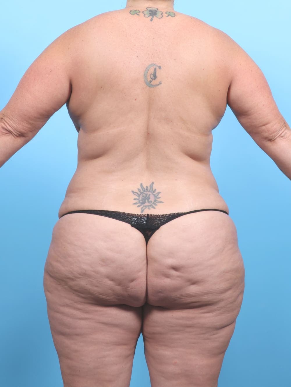 Tummy Tuck case #6793 before, image 4