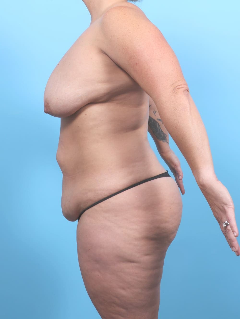 Tummy Tuck case #6793 before, image 3