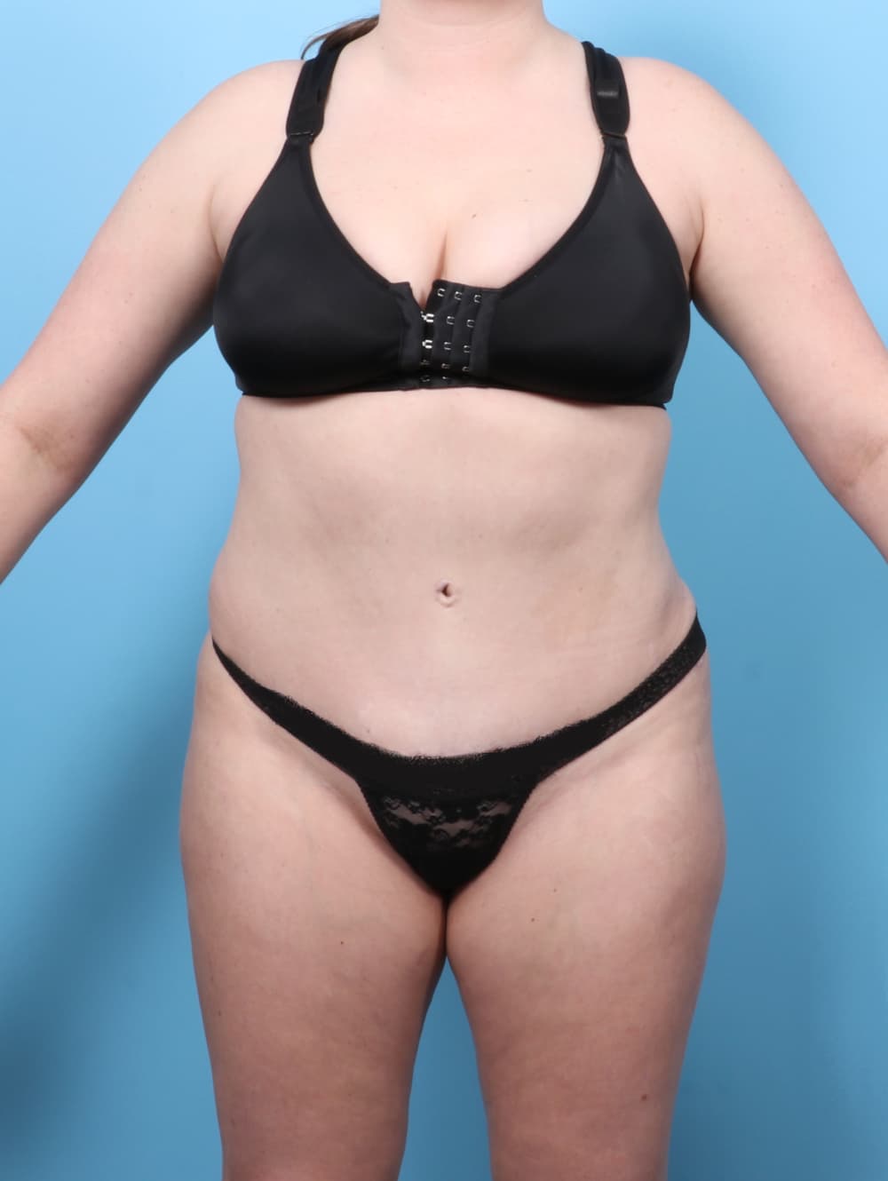 Tummy Tuck case #7650 after