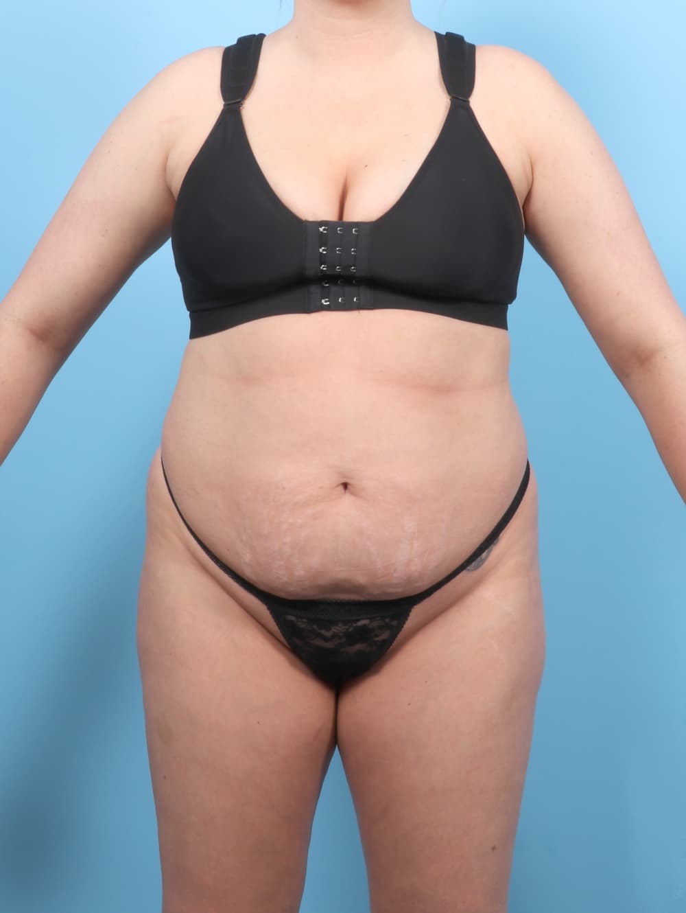 Tummy Tuck case #7650 before