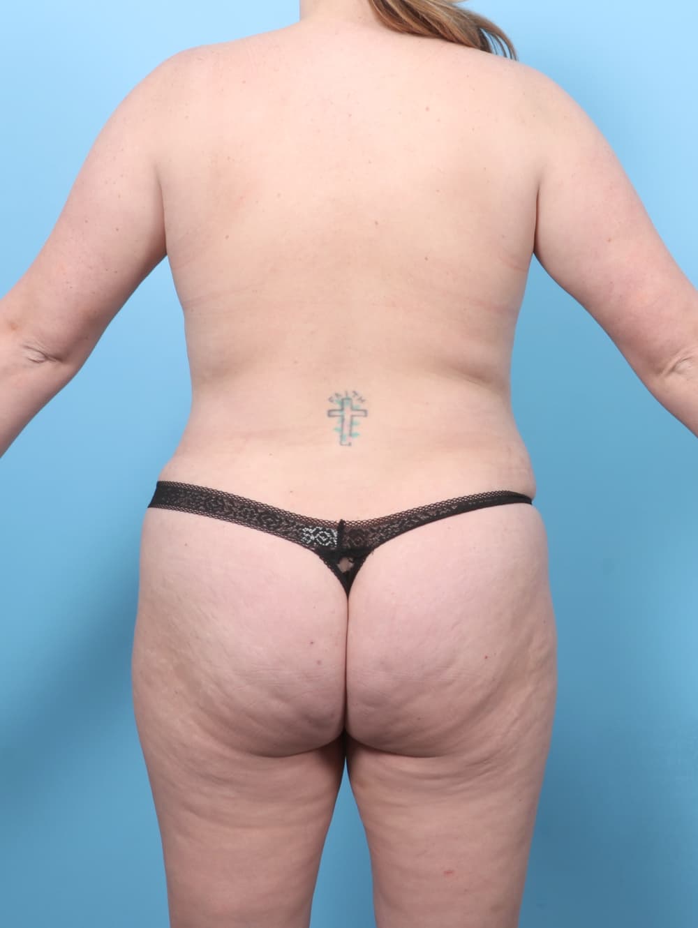 Liposuction case #7650 after, image 2