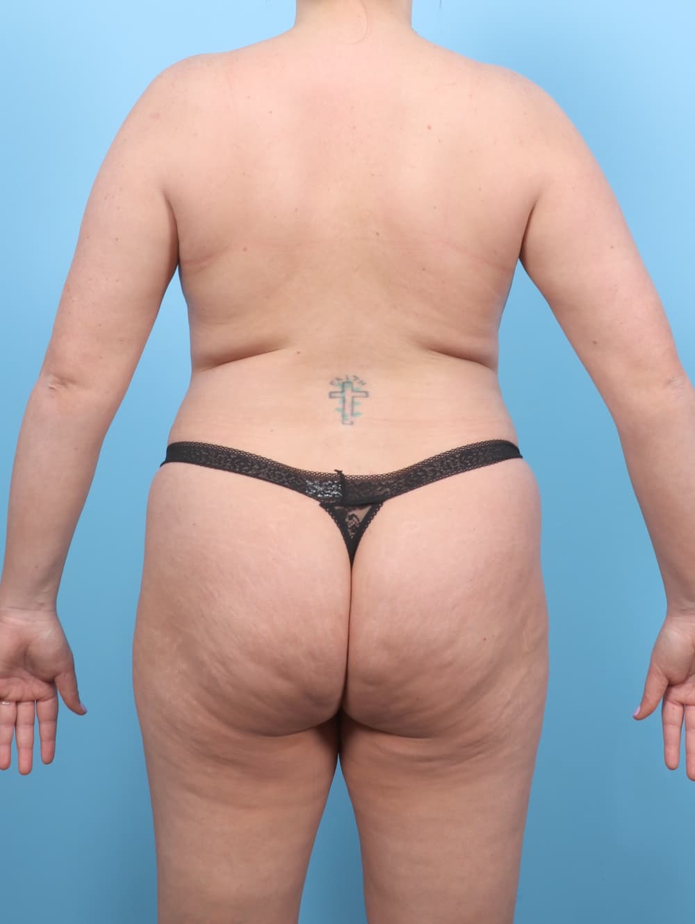Liposuction case #7650 before, image 2