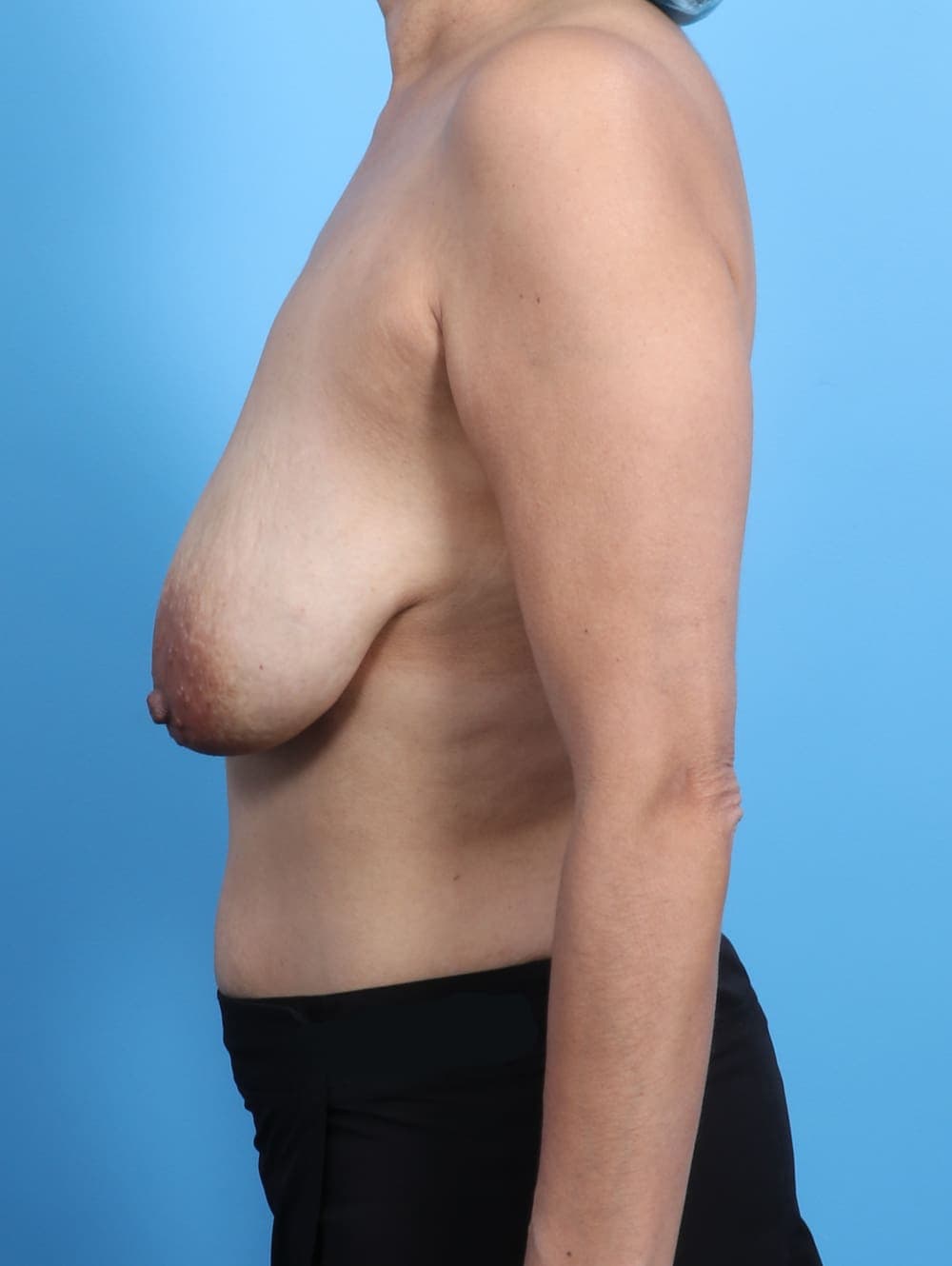 Breast Lift with Implants case #2849 before, image 3