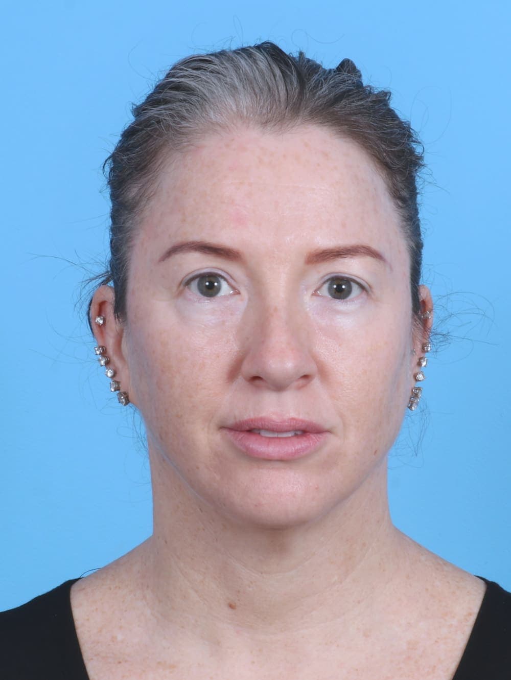Eyelid Surgery case #4245 after