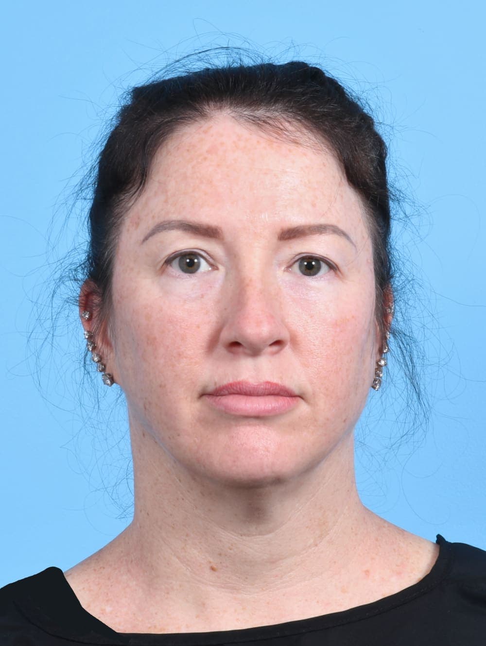 Eyelid Surgery case #4245 before