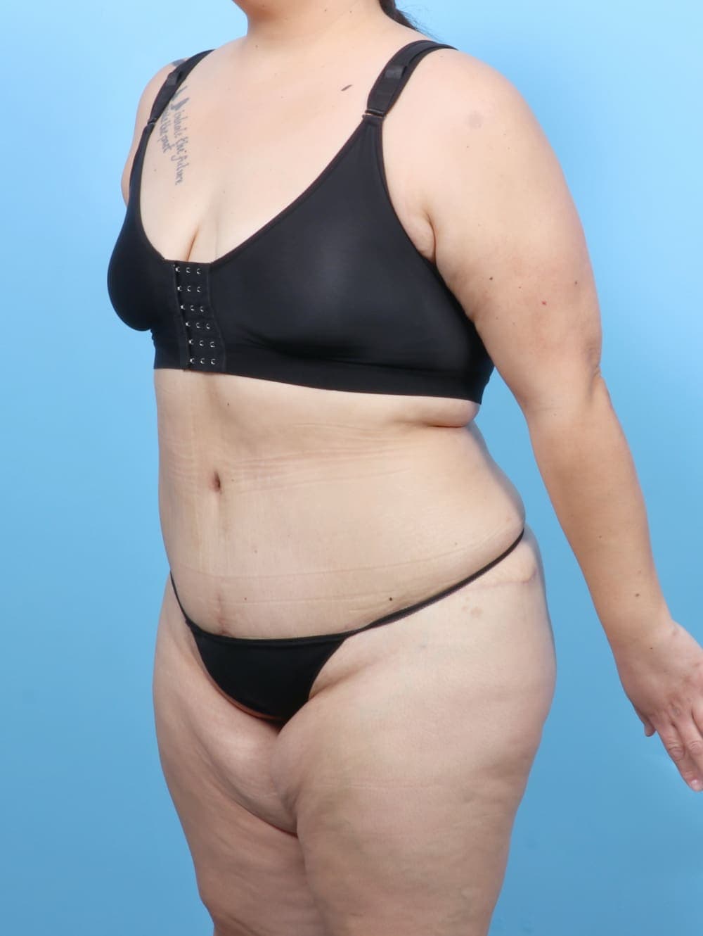 Tummy Tuck case #6383 after, image 2