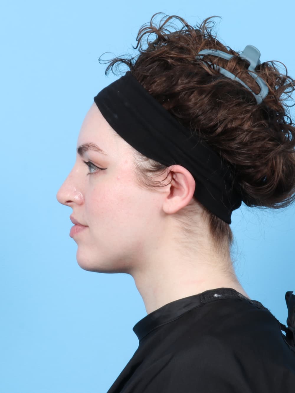 Rhinoplasty case #7839 after, image 1