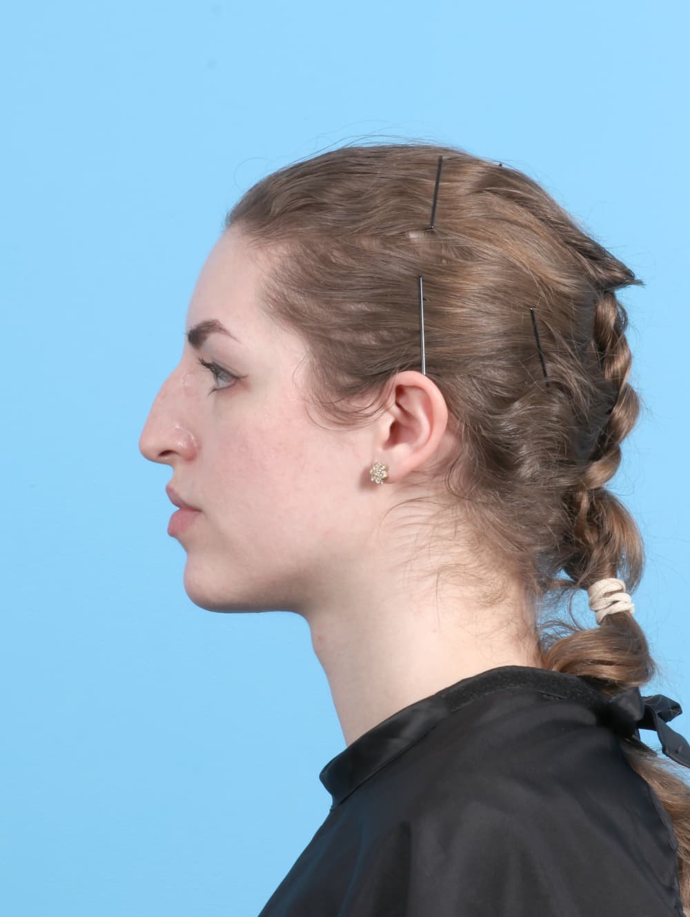 Rhinoplasty case #7839 before, image 1