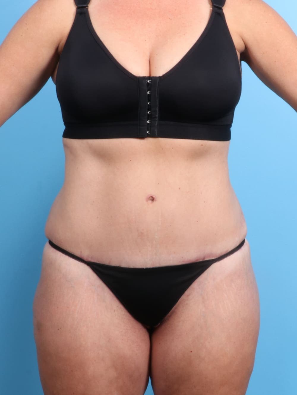 Tummy Tuck case #2032 after, image 1