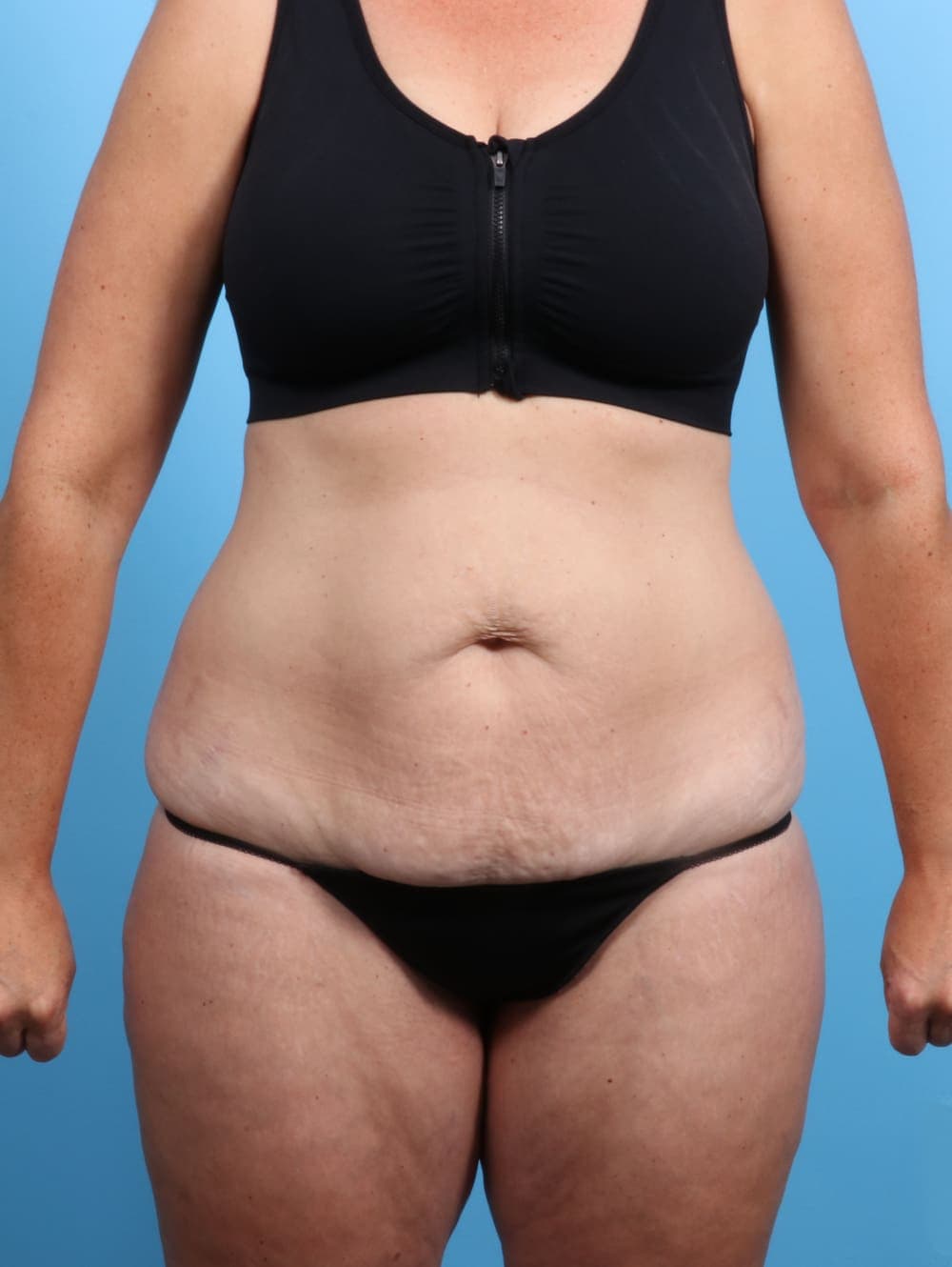 Tummy Tuck case #2032 before, image 1