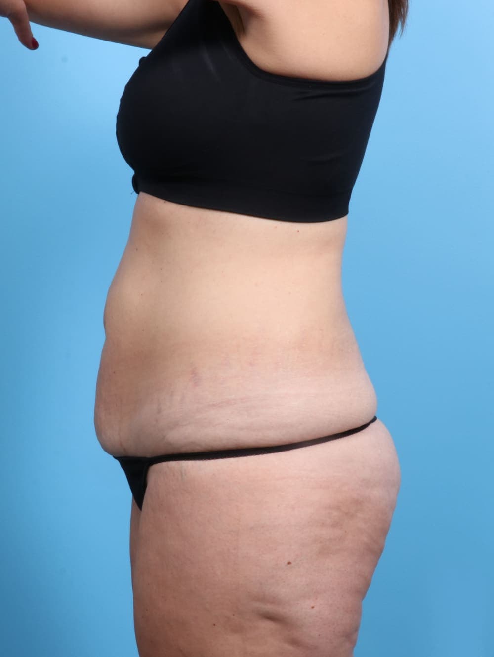 Tummy Tuck case #2032 before, image 3