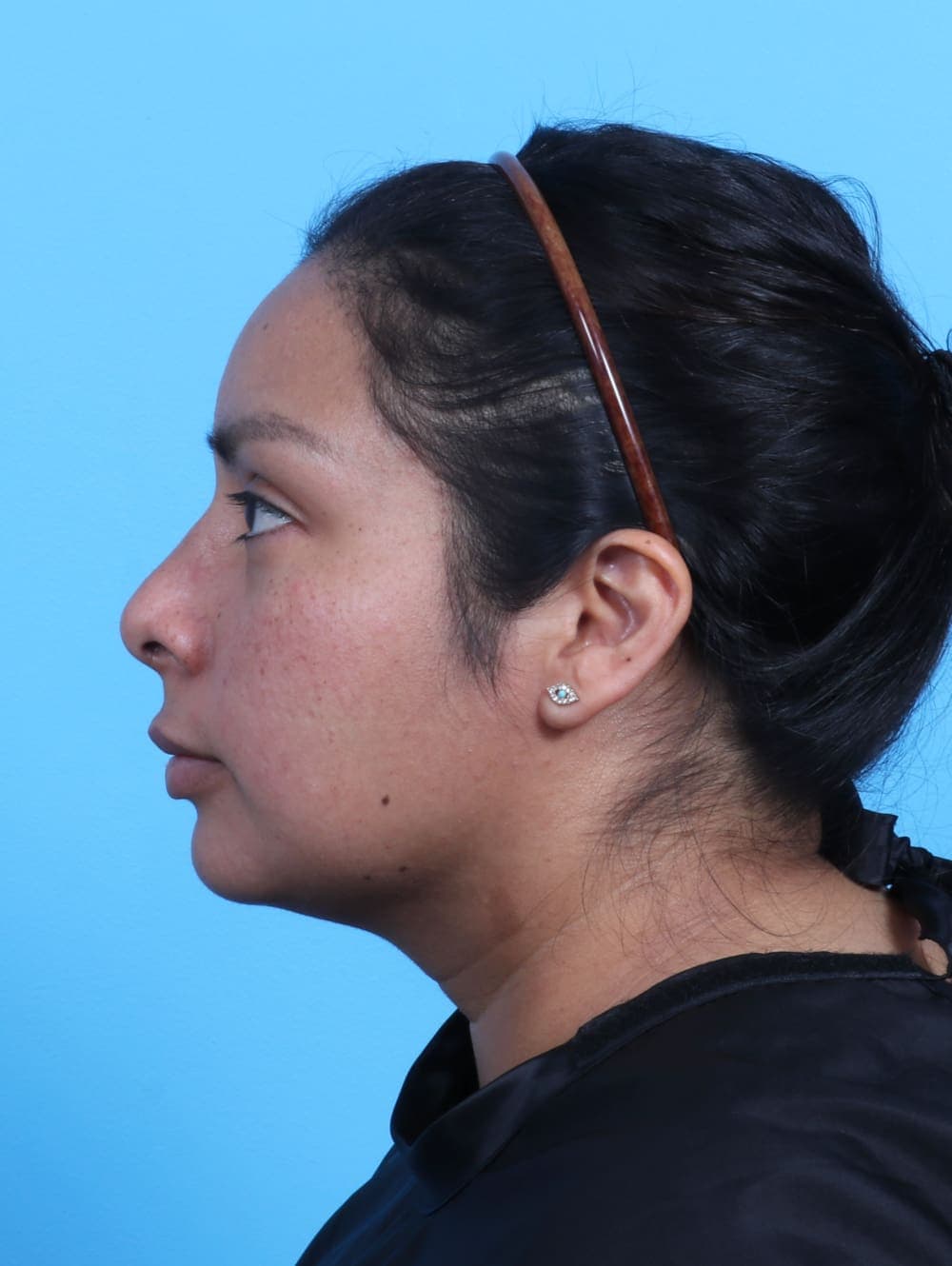 Facial Surgery case #3319 after