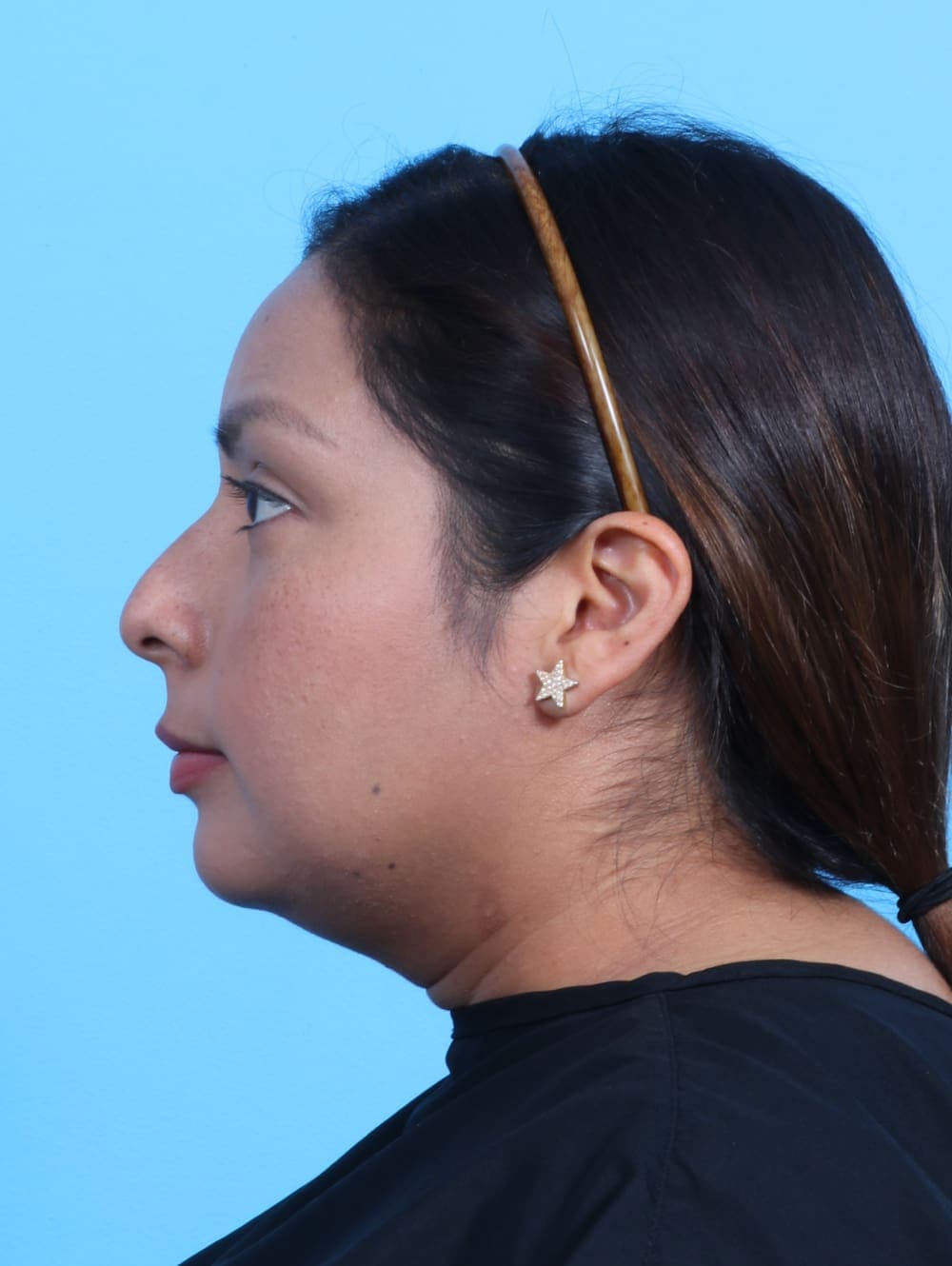 Facial Surgery case #3319 before