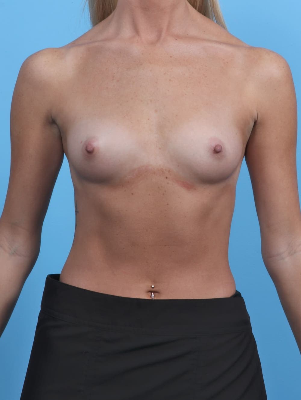 Breast Augmentation case #5626 before