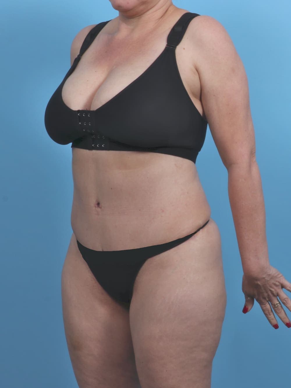 Tummy Tuck case #4874 after, image 2