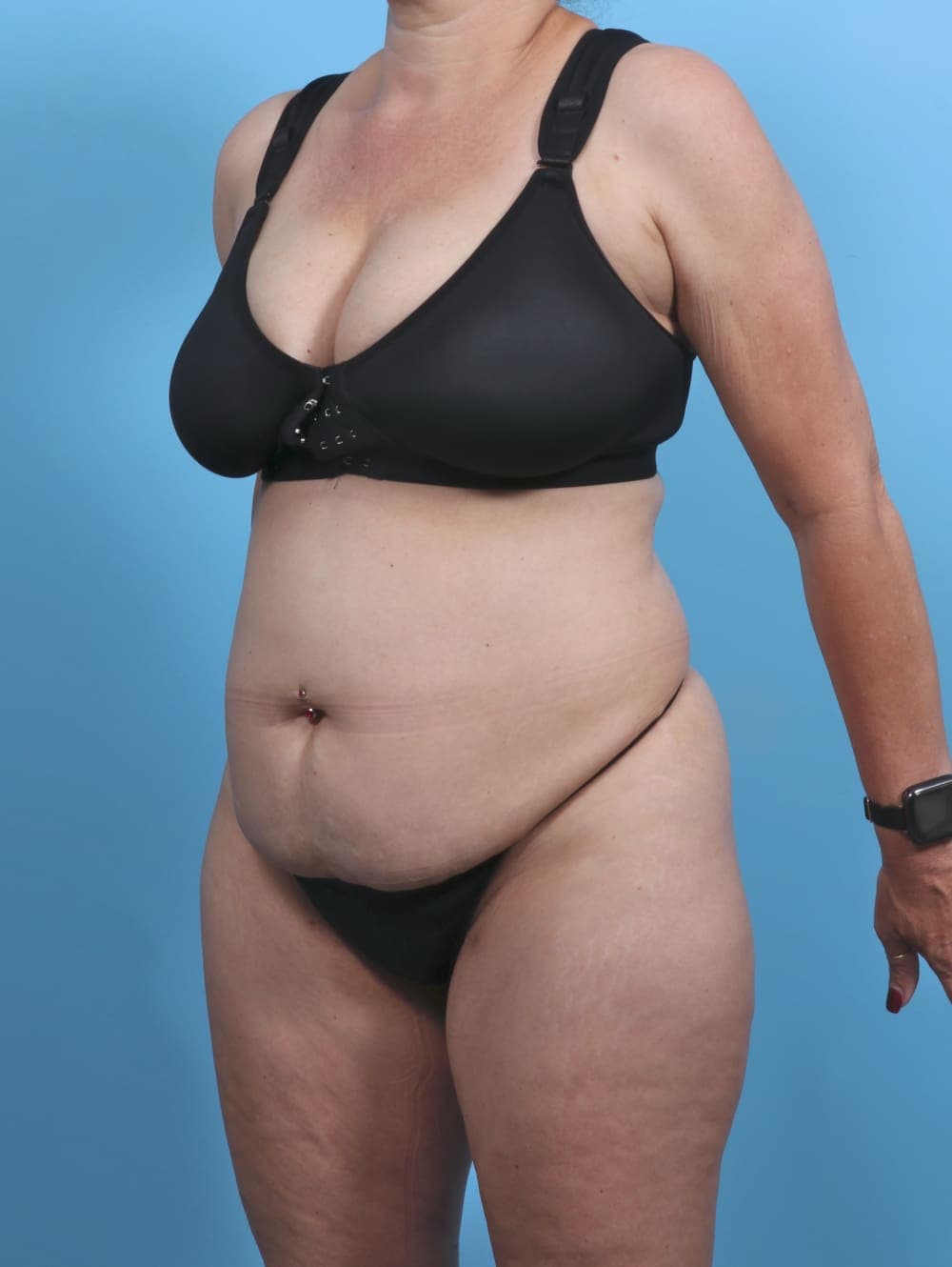 Tummy Tuck case #4874 before, image 2
