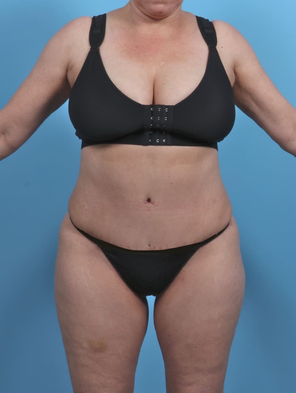 Liposuction case #4874 after