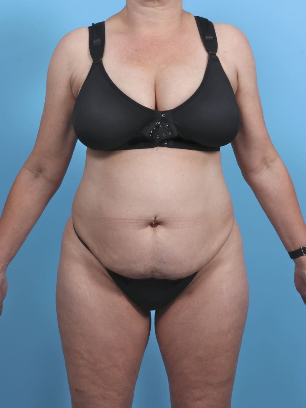 Liposuction case #4874 before