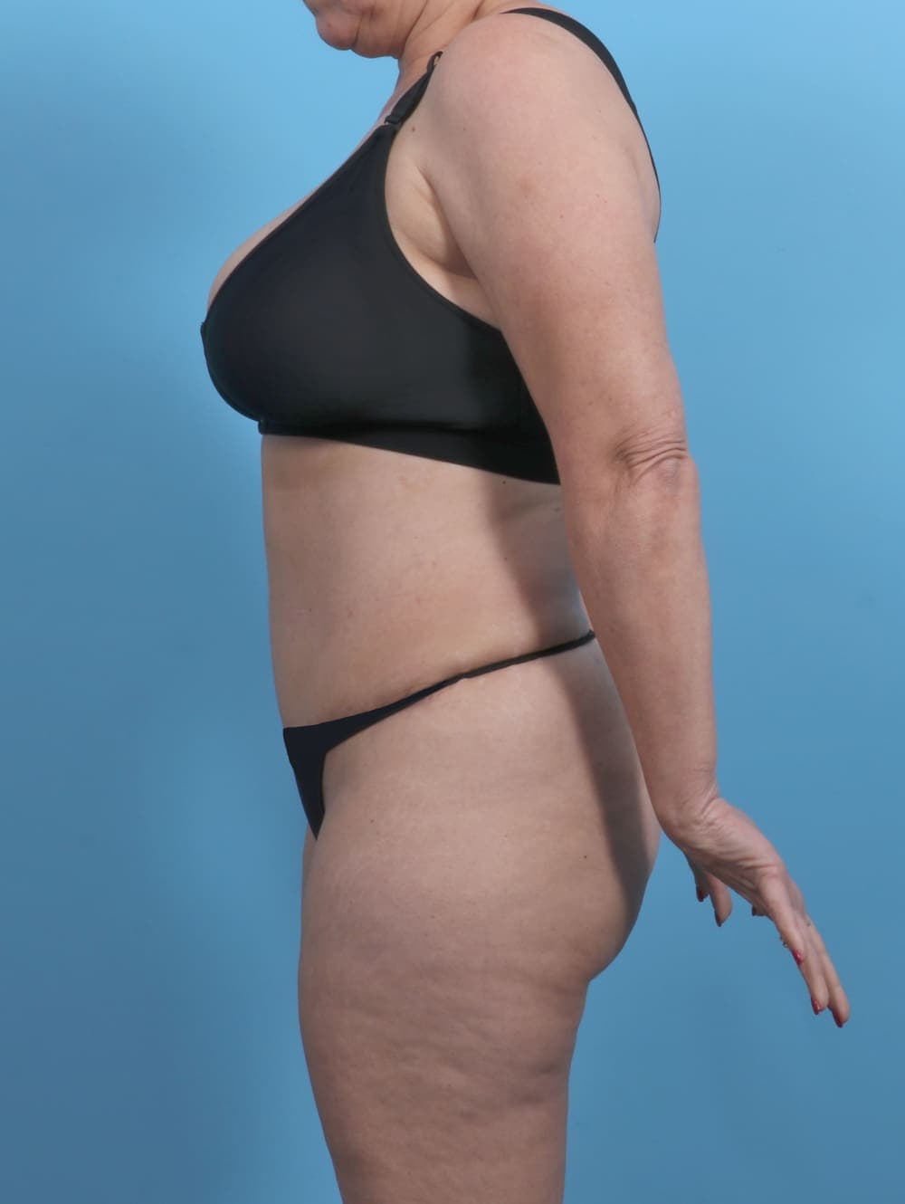 Tummy Tuck case #4874 after, image 3