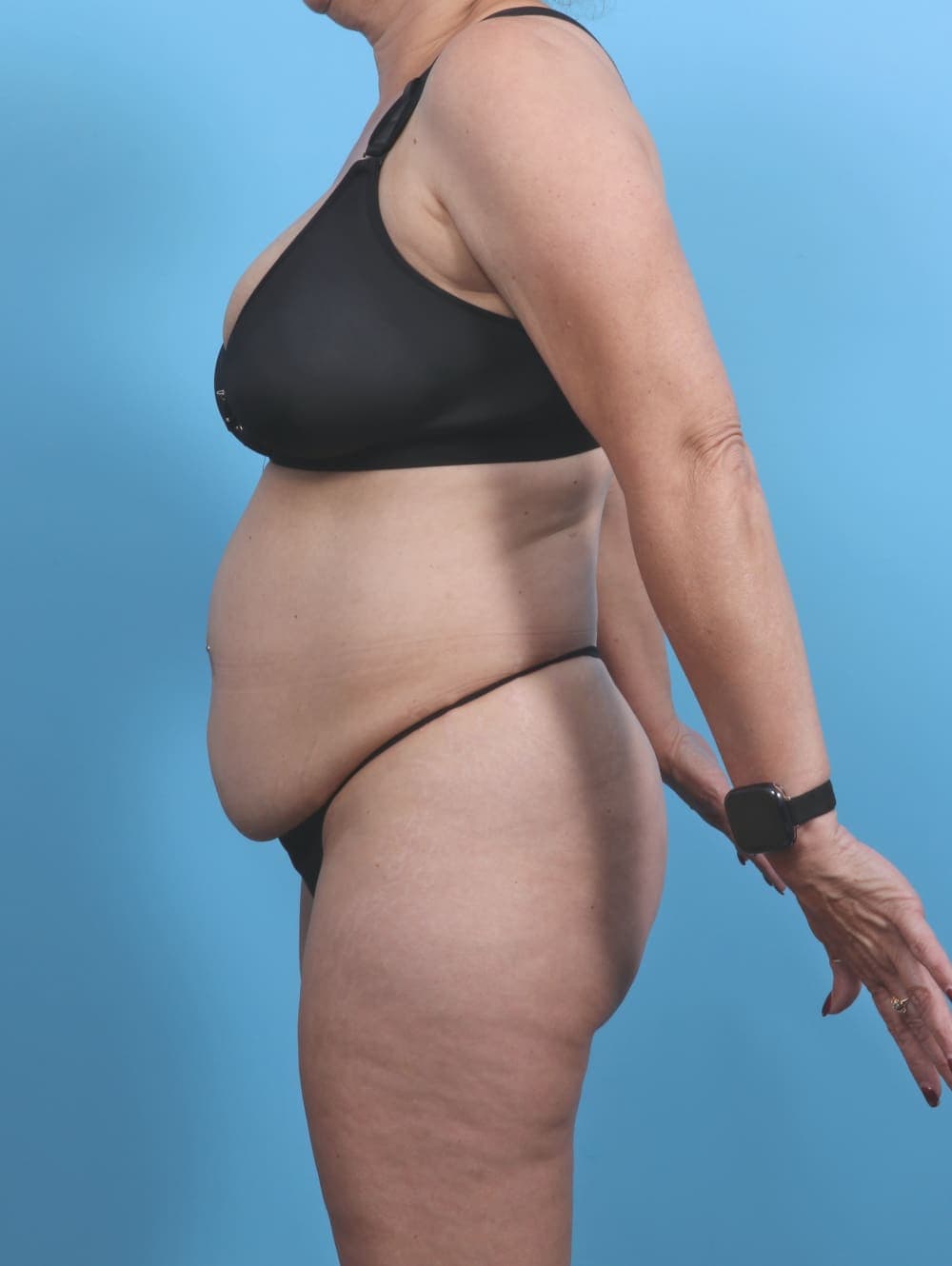Tummy Tuck case #4874 before, image 3