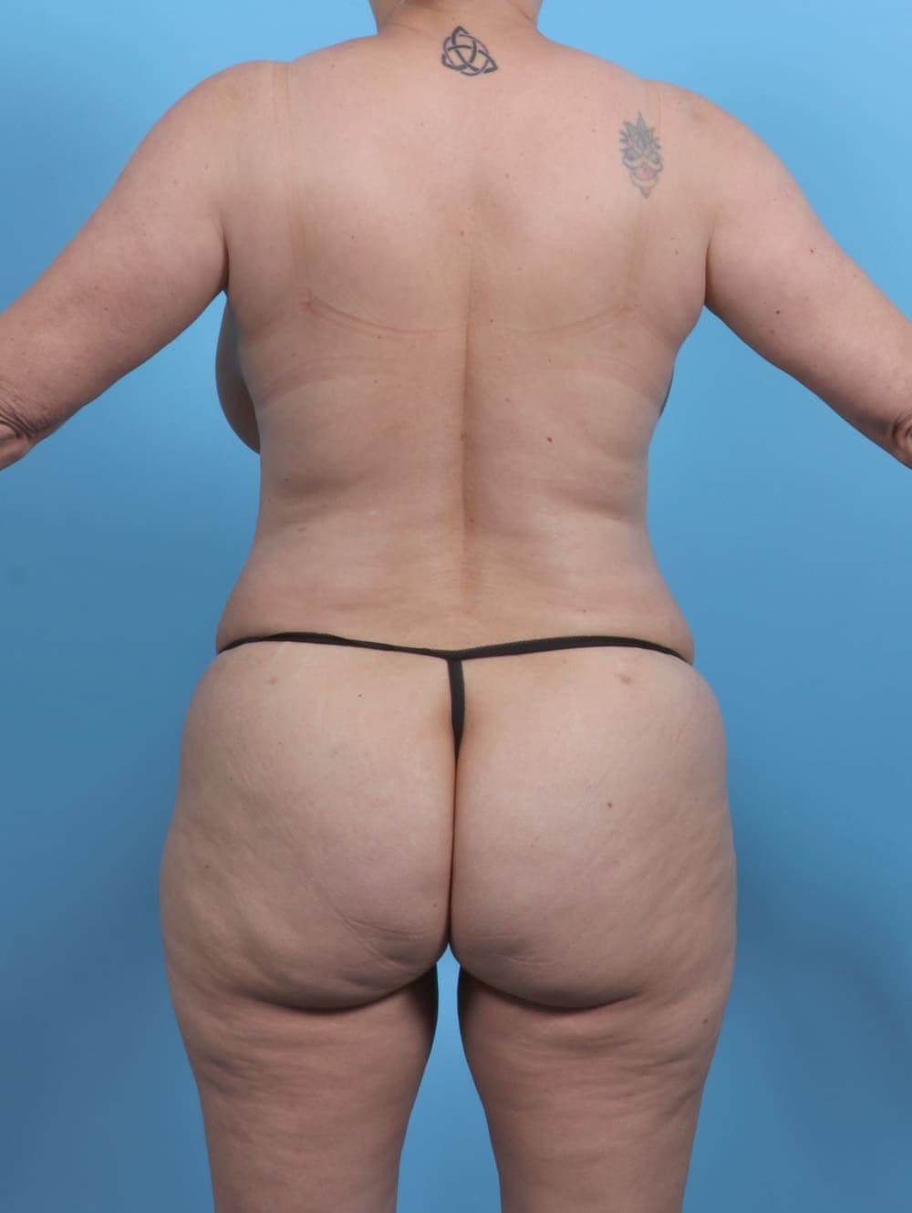 Tummy Tuck case #4874 after, image 4