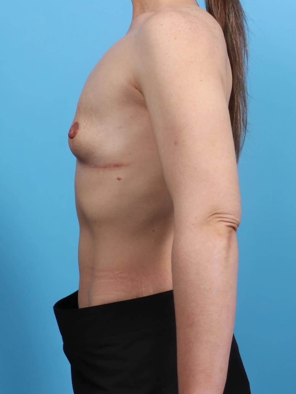 Breast Implant Removal with Lift case #3526 after, image 3