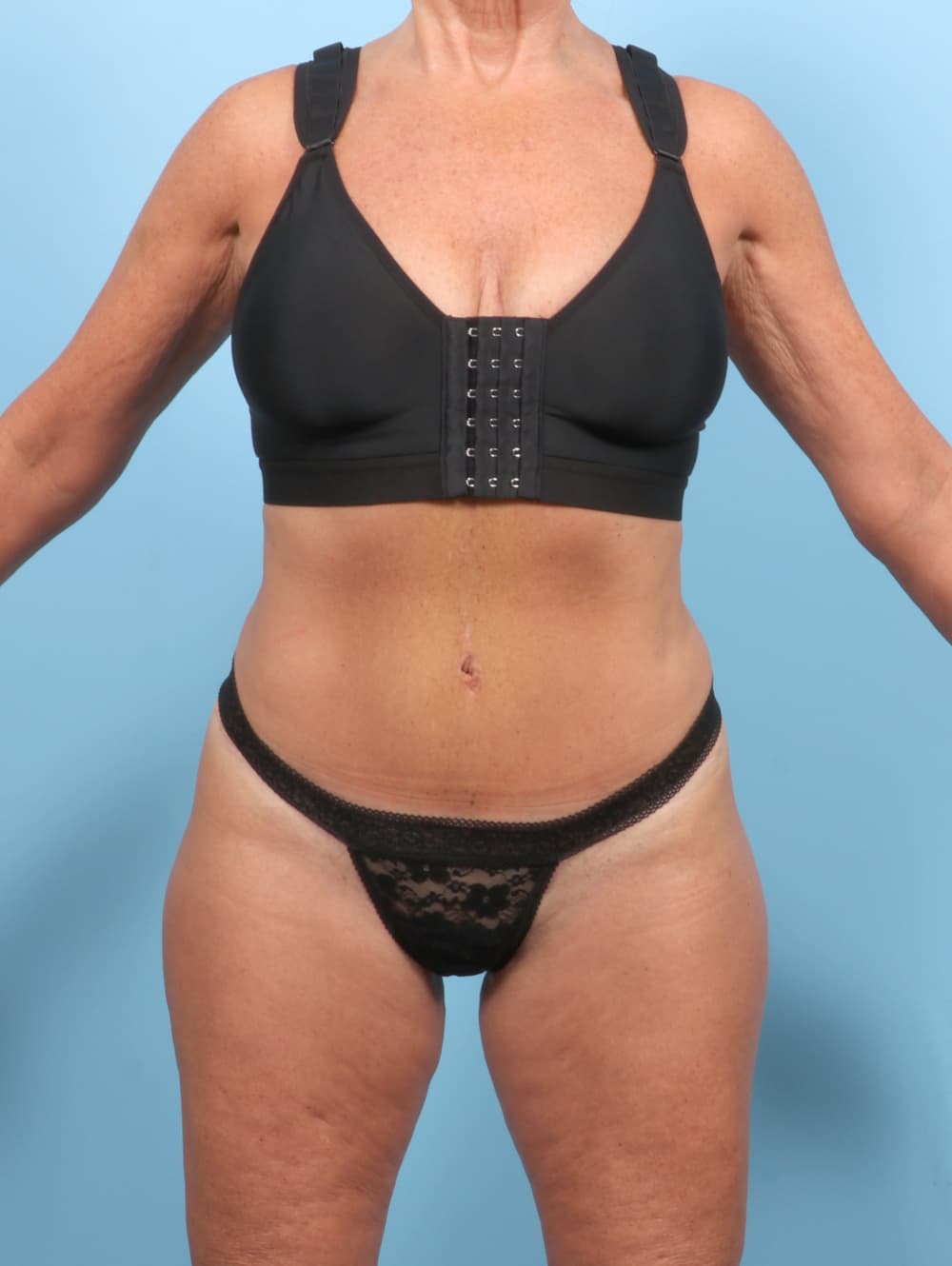 Body Contouring case #7355 after