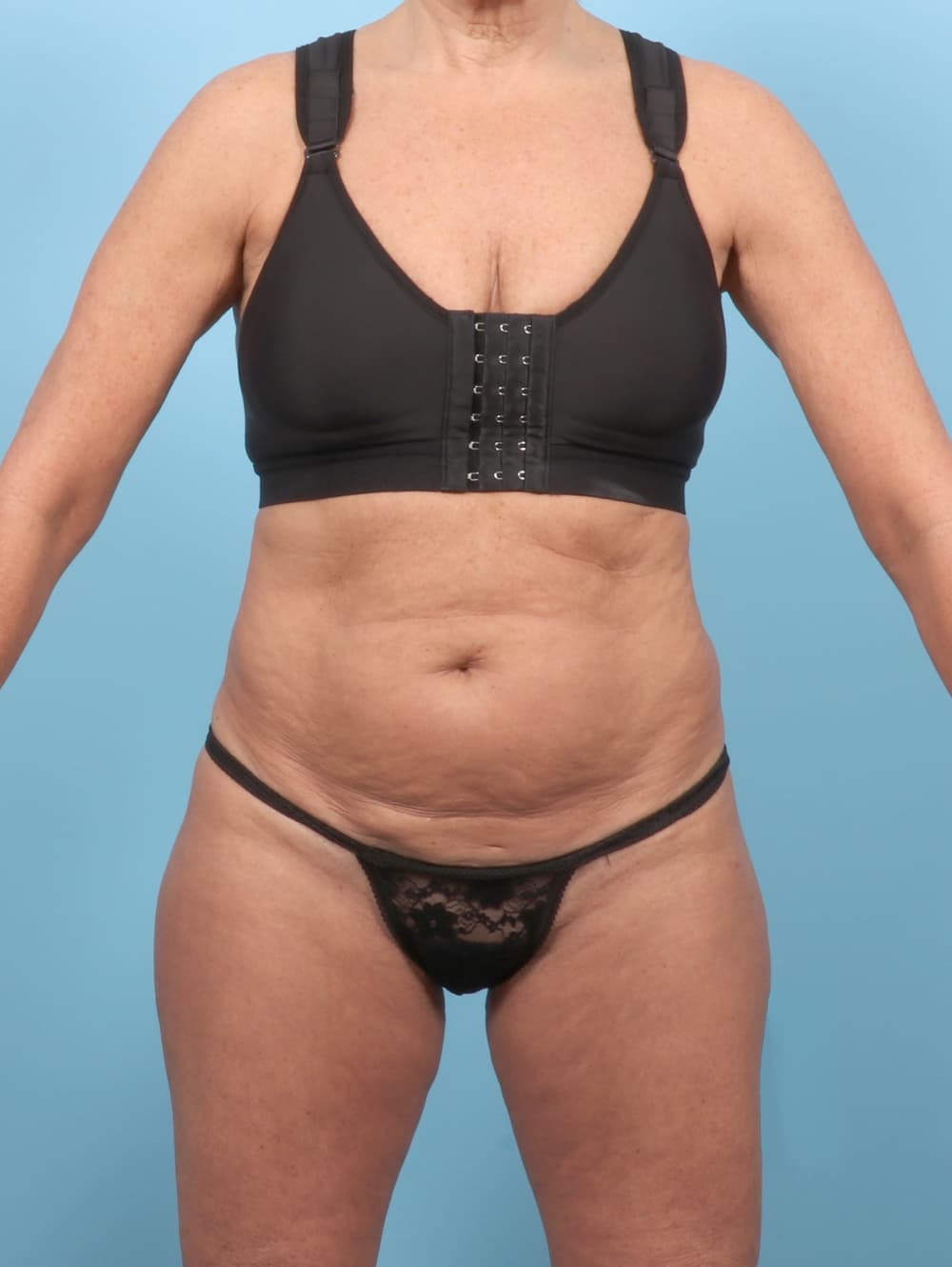 Body Contouring case #7355 before