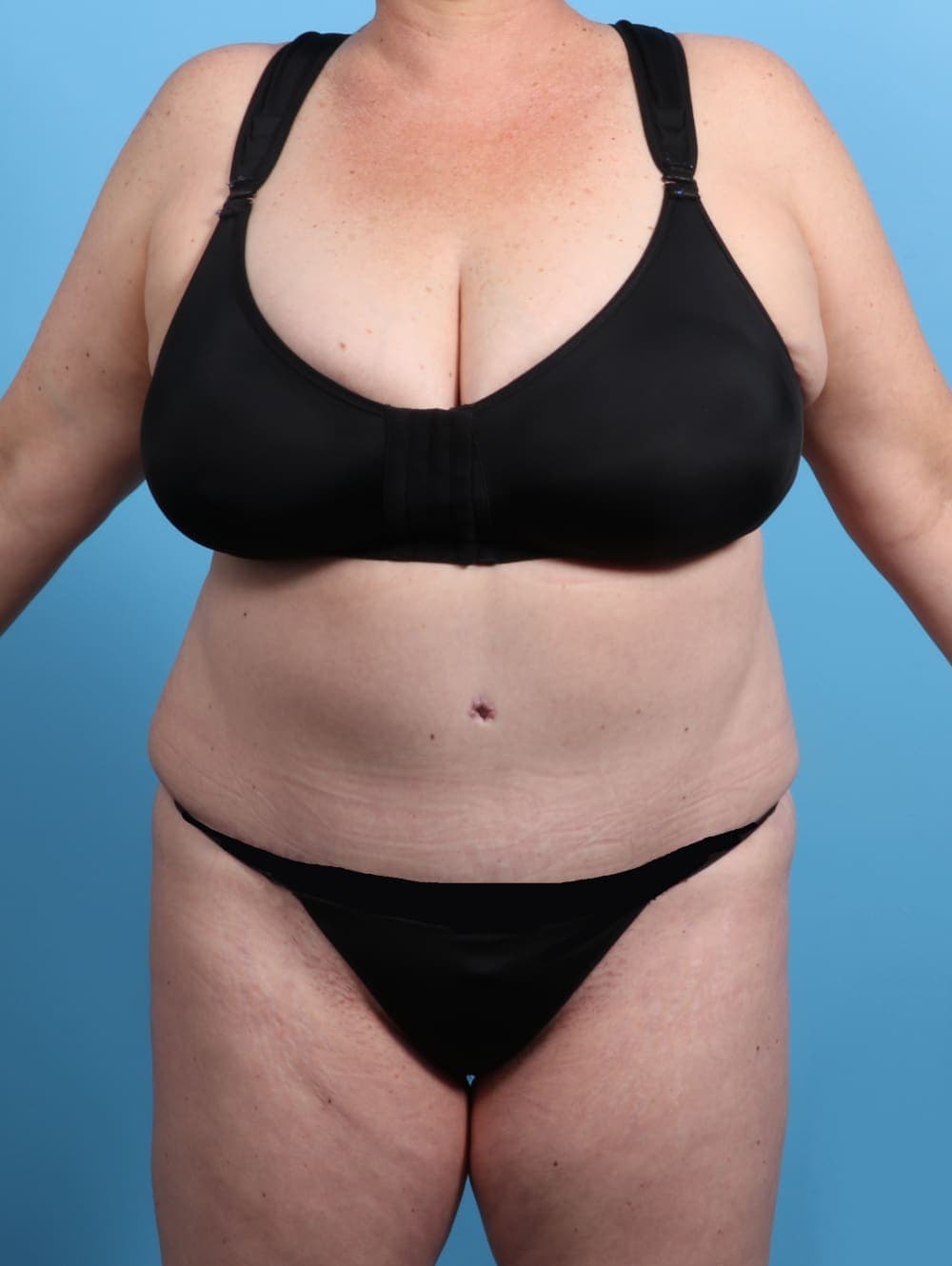 Tummy Tuck case #2825 after, image 1