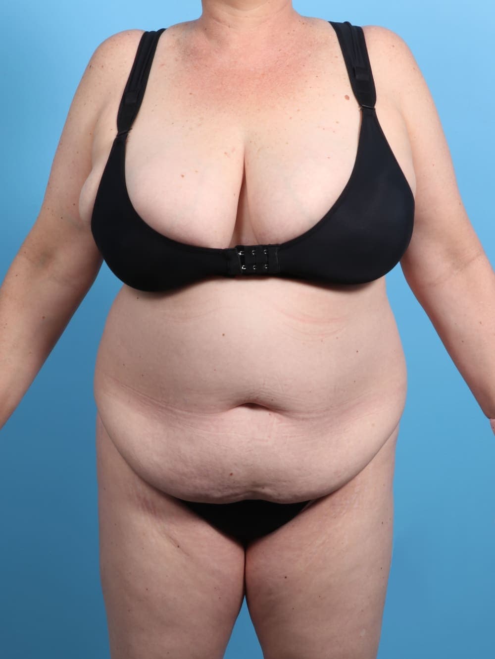 Tummy Tuck case #2825 before, image 1