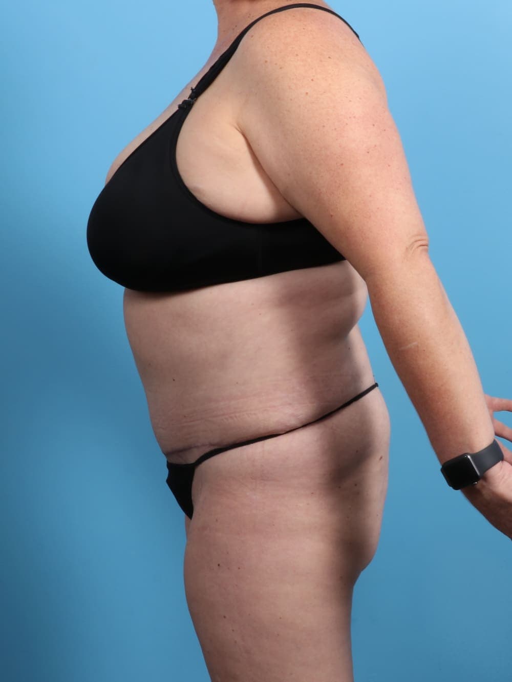 Tummy Tuck case #2825 after, image 3