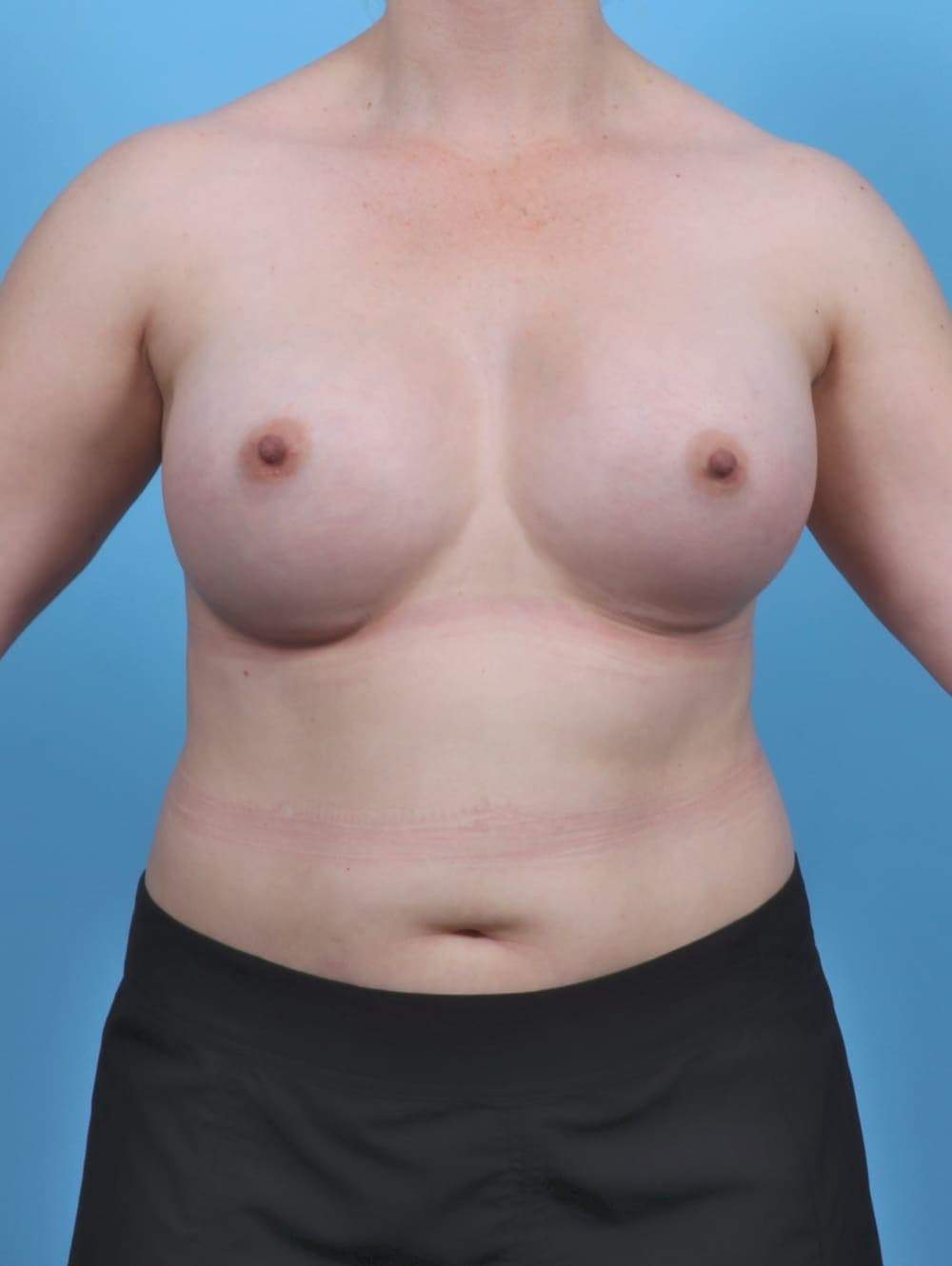 Breast Augmentation case #5506 after