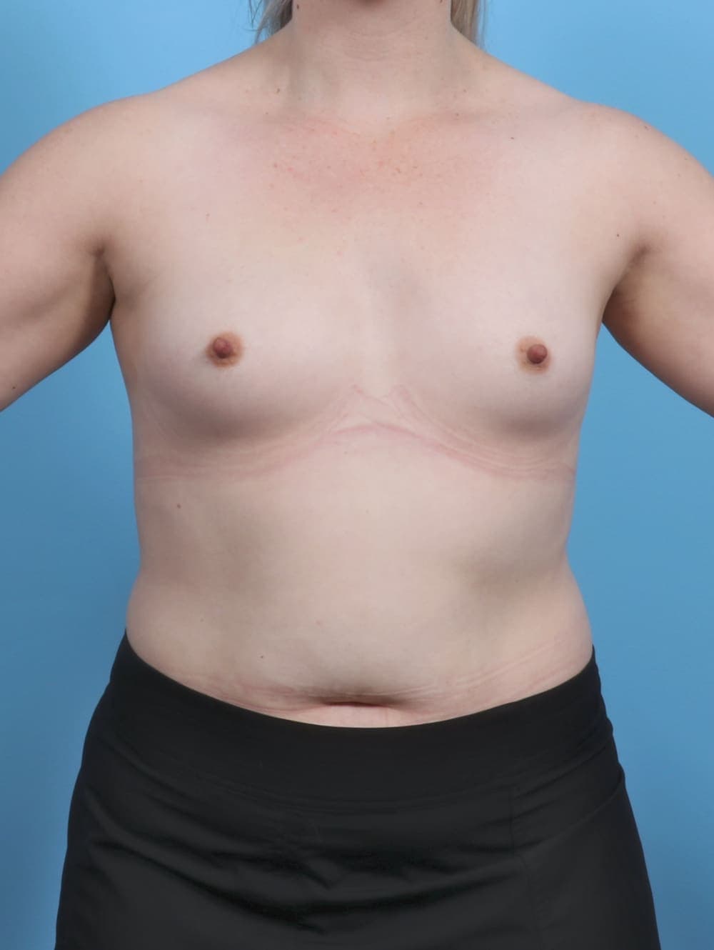 Breast Augmentation case #5506 before