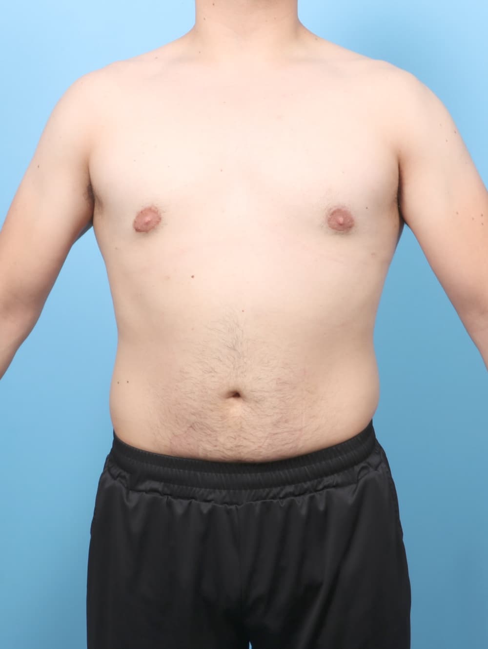 Body Contouring case #7998 after