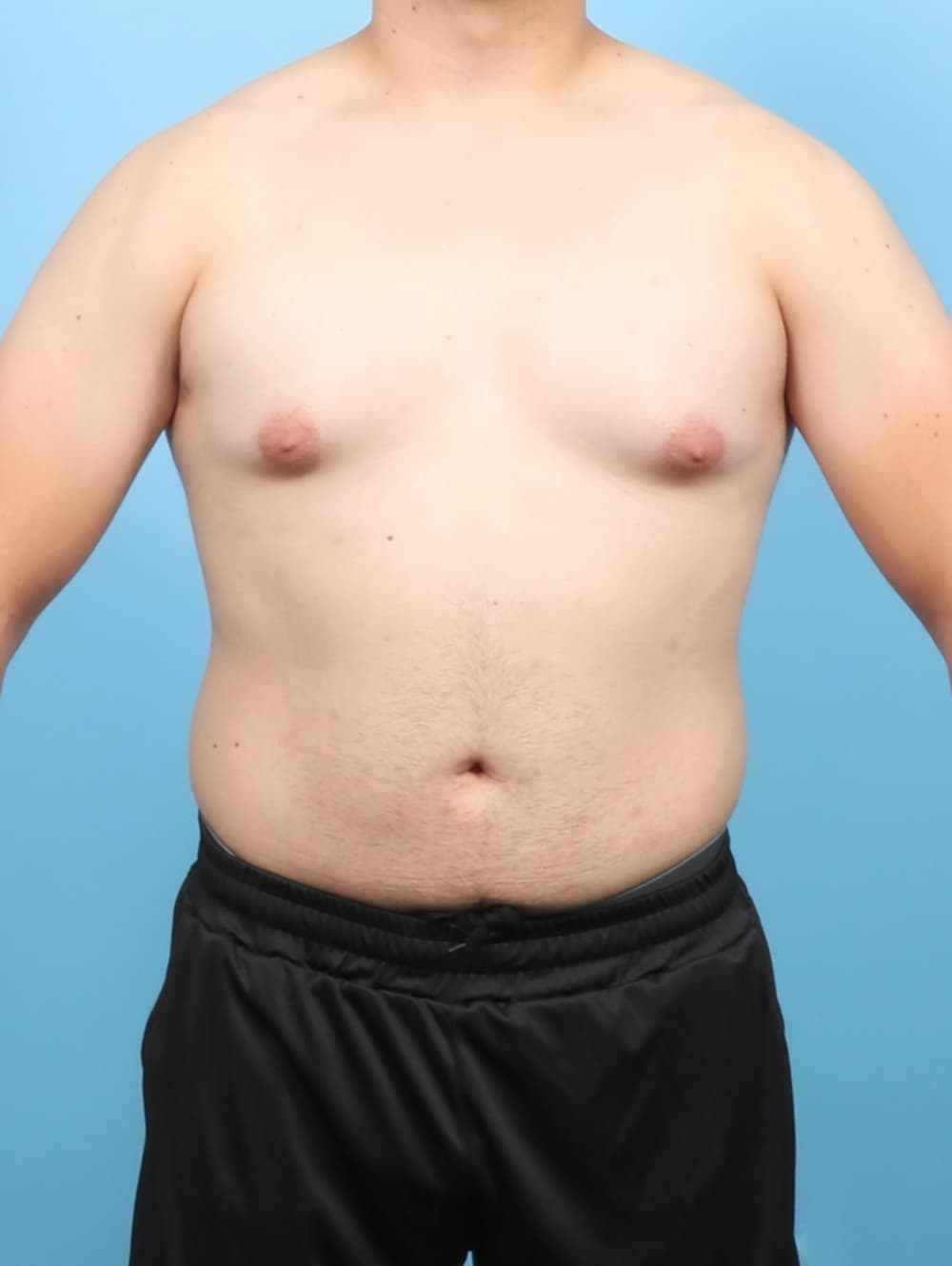 Body Contouring case #7998 before