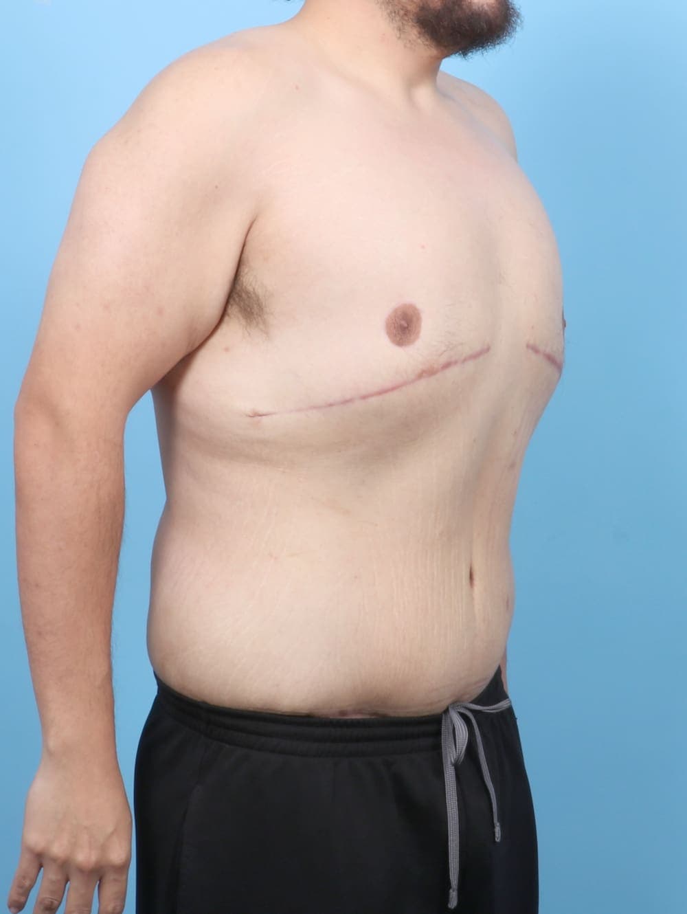Body Lift case #6417 after, image 3