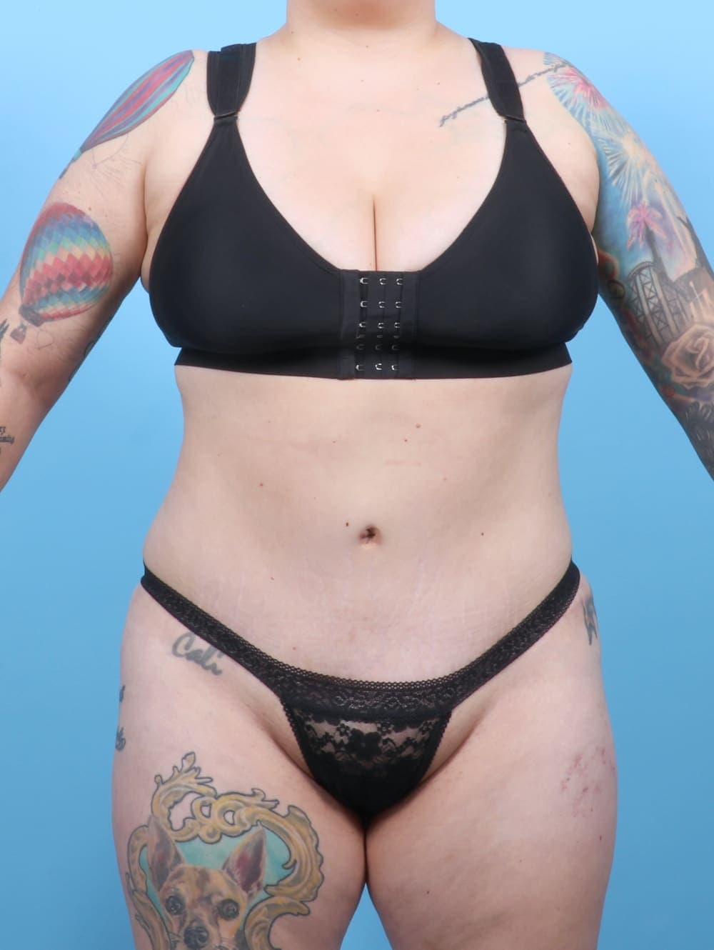 Liposuction case #6325 after