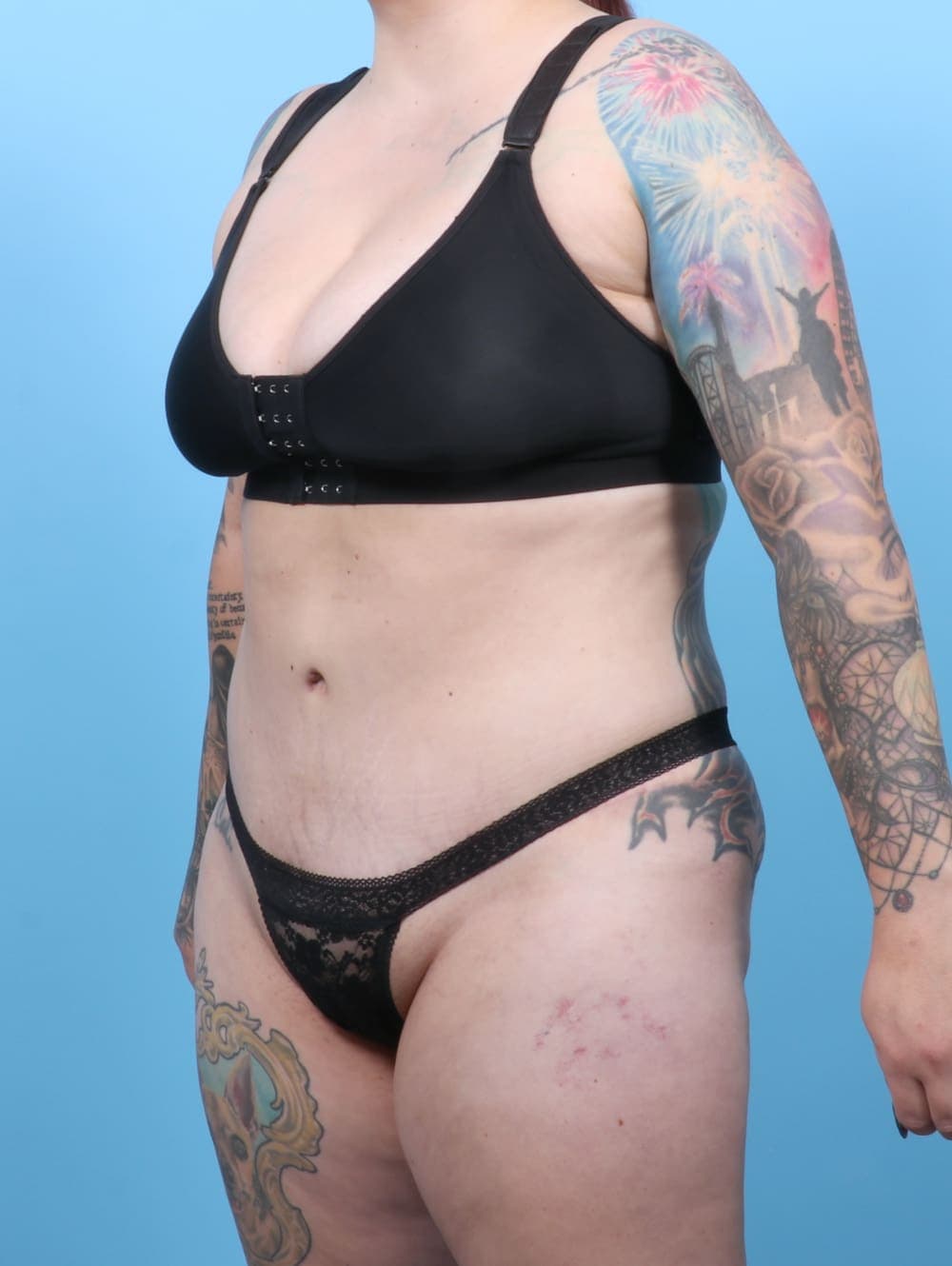 Liposuction case #6325 after, image 3