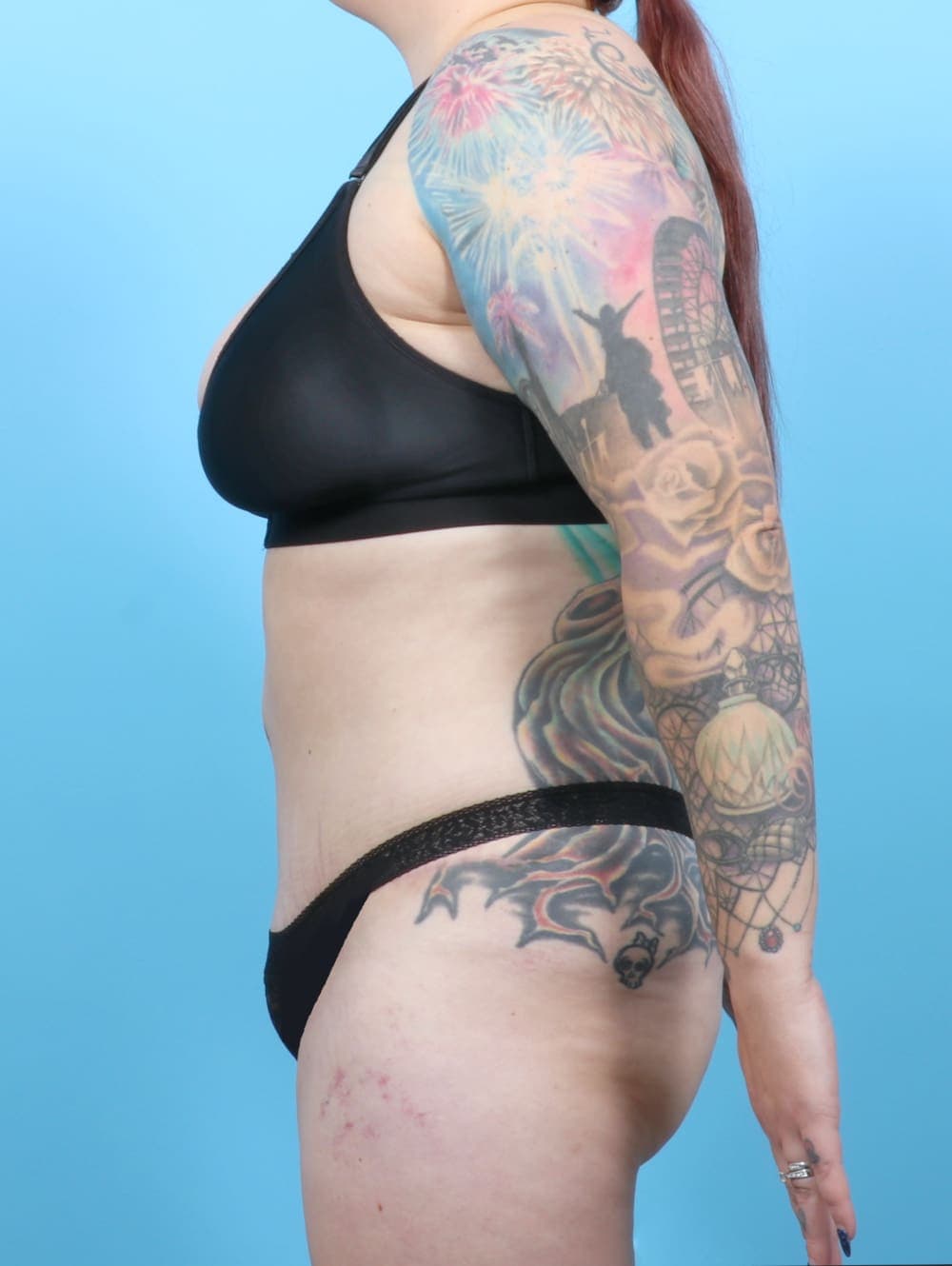 Liposuction case #6325 after, image 4