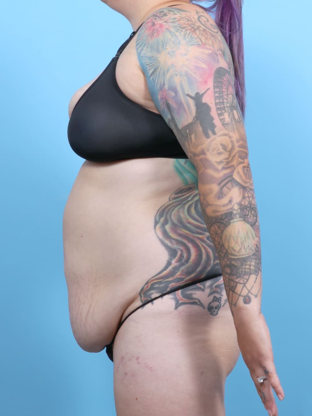 Liposuction case #6325 before, image 4
