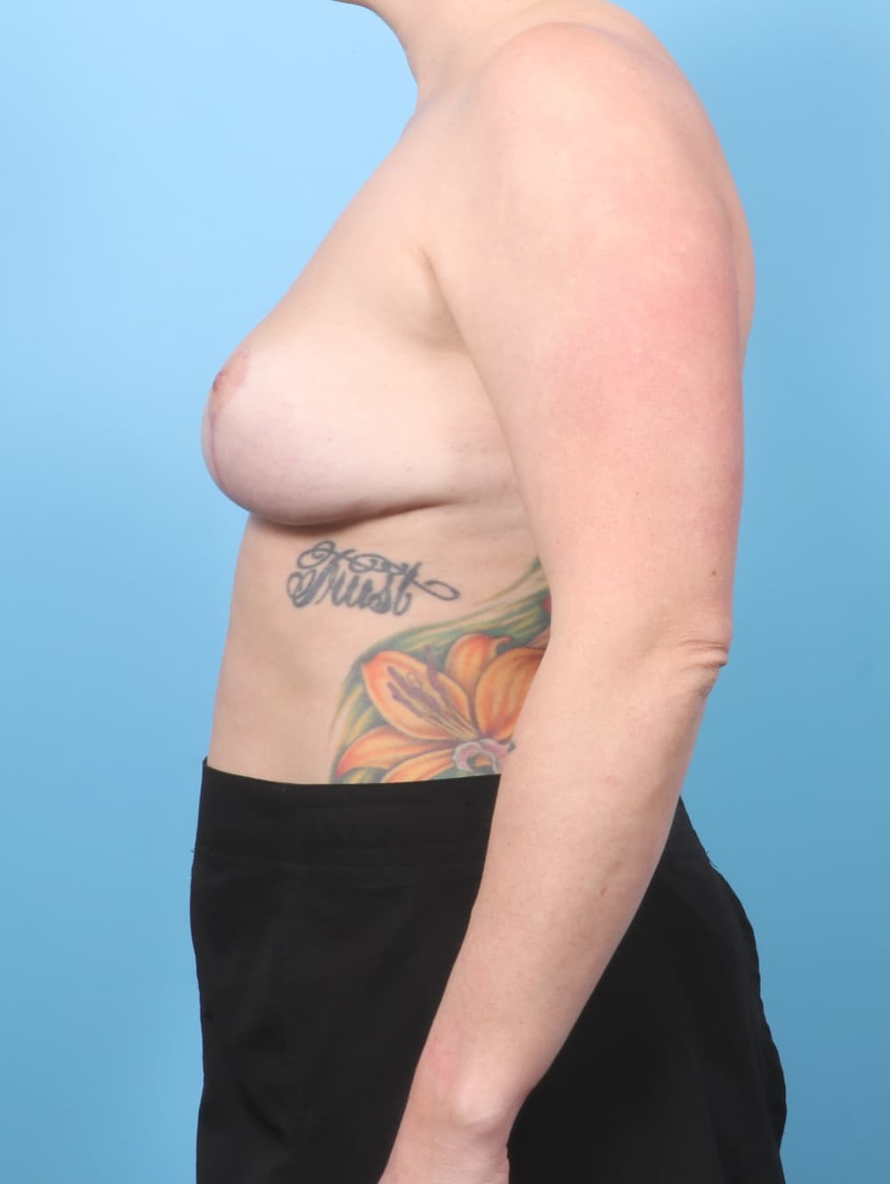 Breast Implant Removal with Lift case #7799 after, image 3