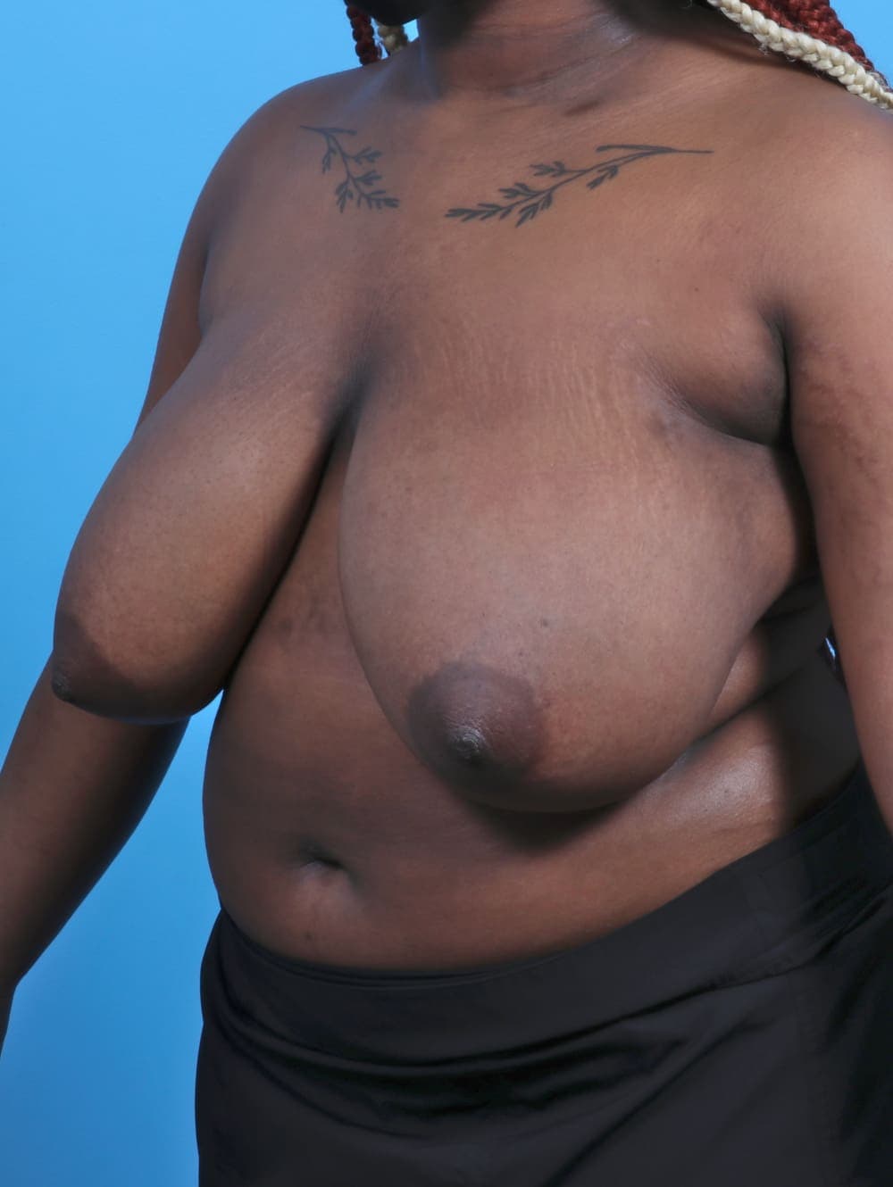 Breast Lift/Reduction case #4561 before, image 2