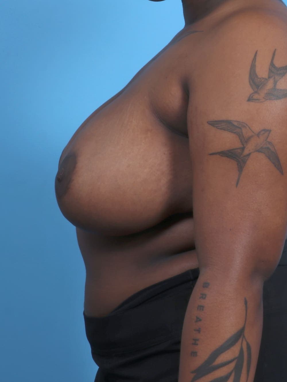 Breast Lift/Reduction case #4561 after, image 3