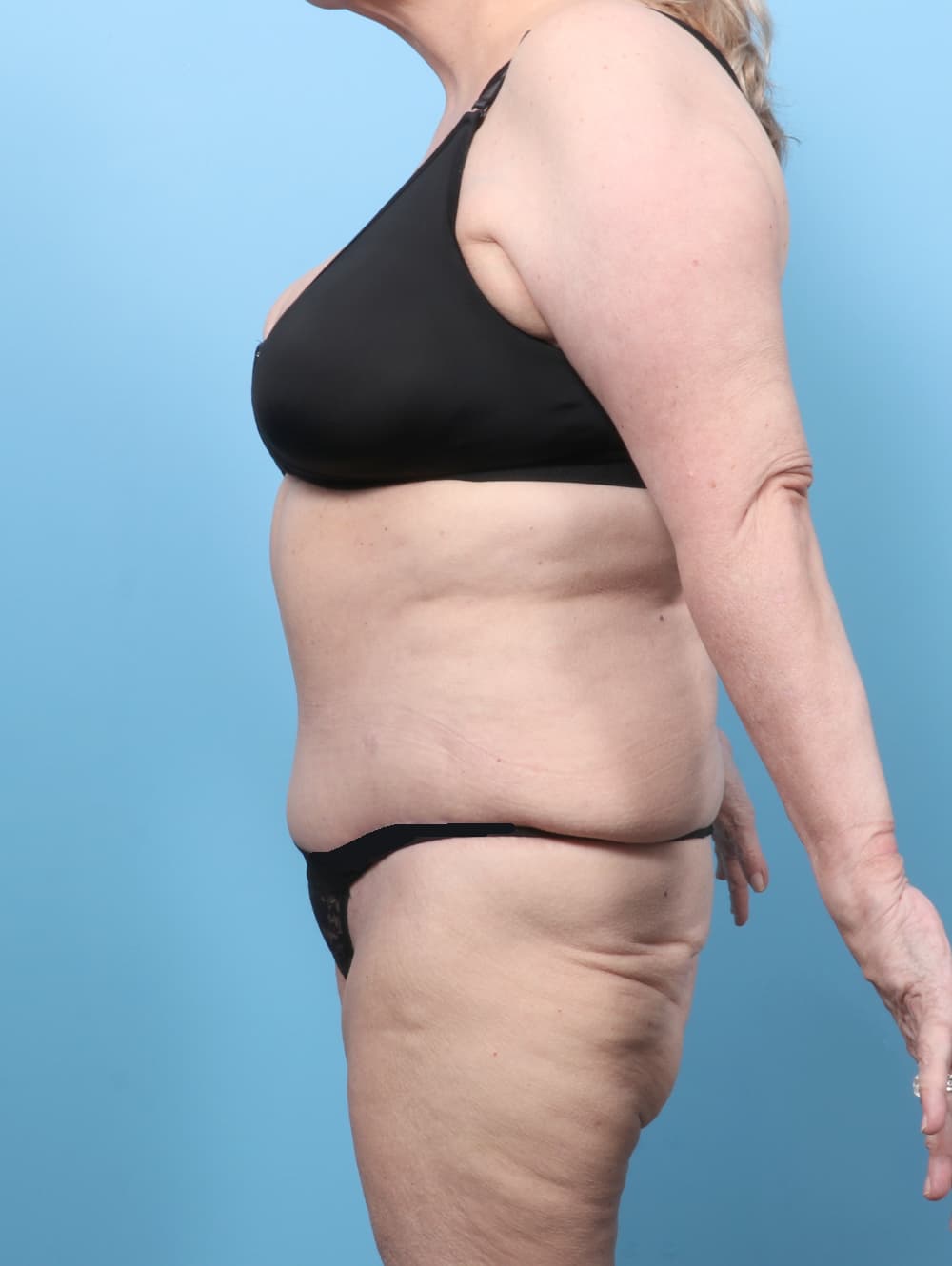 Tummy Tuck case #8511 after, image 3