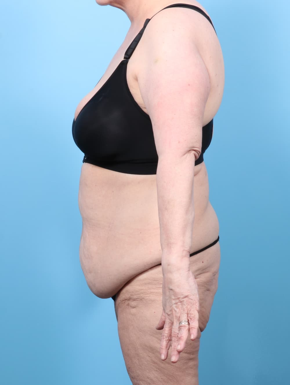 Tummy Tuck case #8511 before, image 3