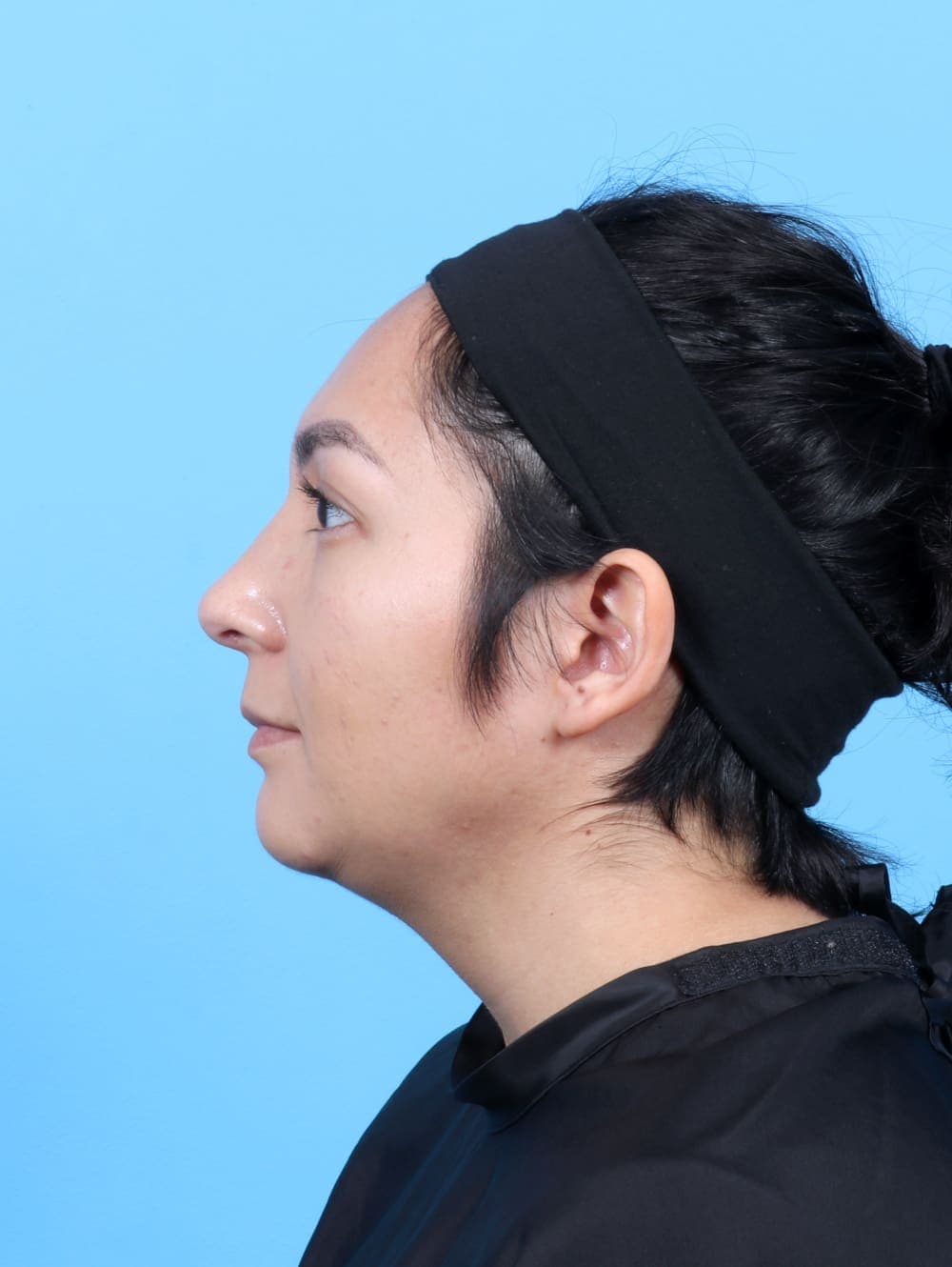 Facial Surgery case #6531 after
