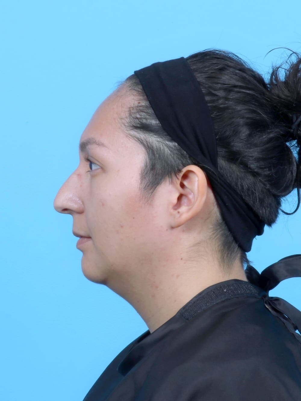 Facial Surgery case #6531 before