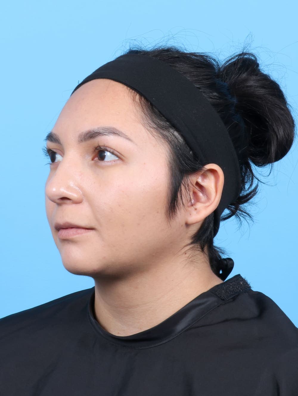 Liposuction case #6531 after, image 3