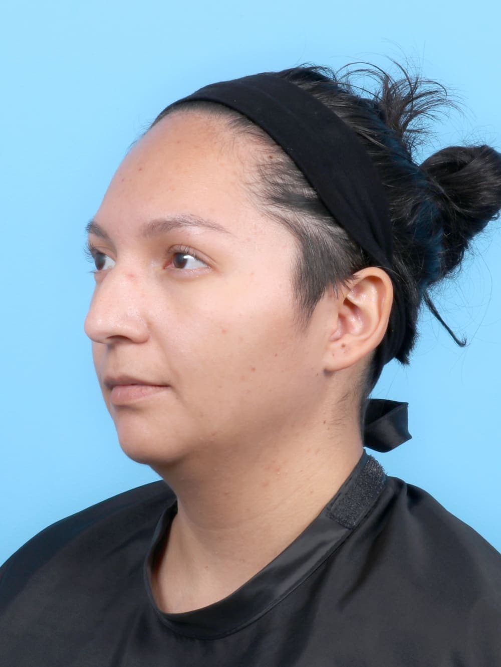 Liposuction case #6531 before, image 3